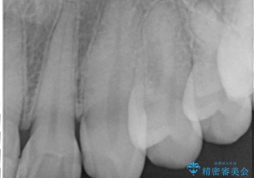 虫歯でかけた上の前歯　セラミック治療の治療前