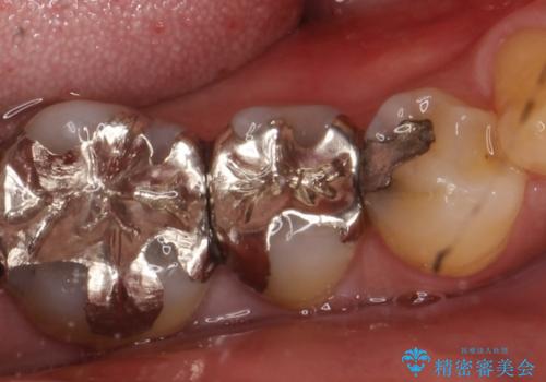銀歯の下に2次的な虫歯が　土台からのやり直しの治療前