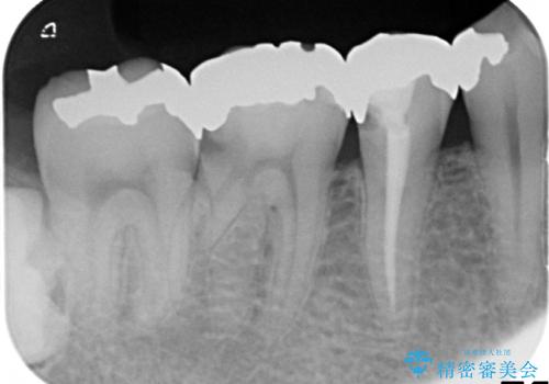 銀歯の下に2次的な虫歯が　土台からのやり直しの治療前