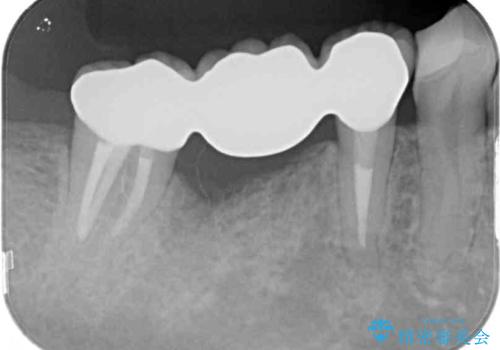歯が割れている　オールセラミックによる奥歯のブリッジの治療後