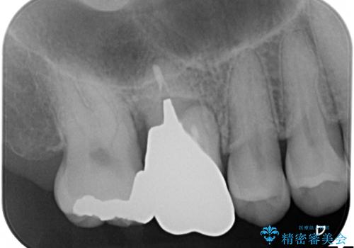 上の奥歯が抜歯になってしまった　インプラントによる修復の治療前