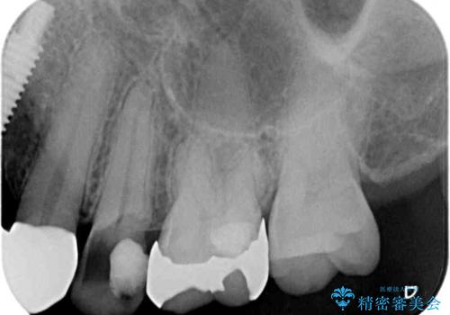 歯茎の中にまで及んだ大きなむし歯　抜歯をせずにセラミッククラウンにの治療前