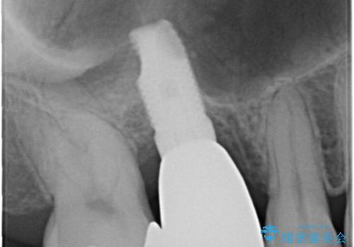 上の奥歯が抜歯になってしまった　インプラントによる修復の治療後