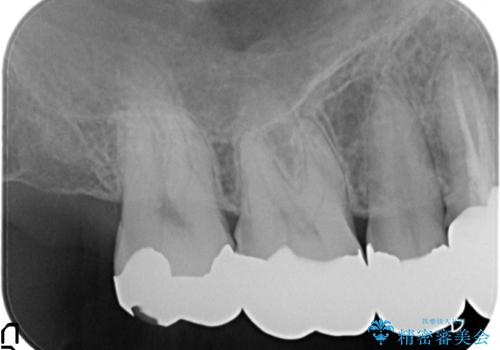 [ジルコニアクラウン] 銀歯を白く　臼歯部メタルフリー治療の治療前