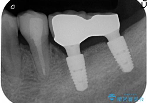 歯に穴が開いている　抜歯してインプラントへ　30代男性の治療後