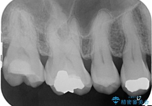 奥歯の詰め物が外れてしまった　金合金による修復の治療前