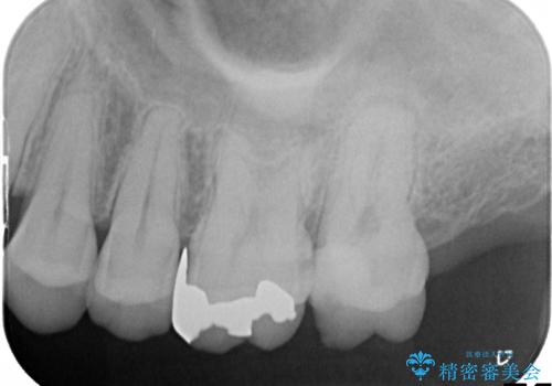 奥歯が痛む　根管治療→セラミックによるかみ合わせの回復までの治療前