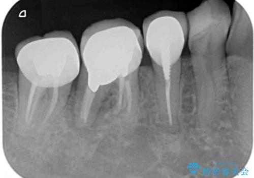 歯が割れている　オールセラミックによる奥歯のブリッジの治療前