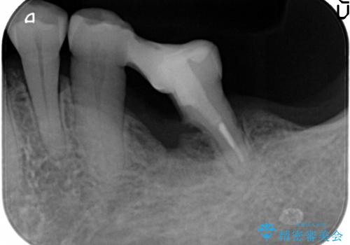 [ 骨造成を伴う臼歯部インプラント治療 ① ]  抜歯を行い骨造成、インプラントの埋入の治療前