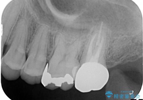 奥歯が痛む　根管治療→セラミックによるかみ合わせの回復までの治療後