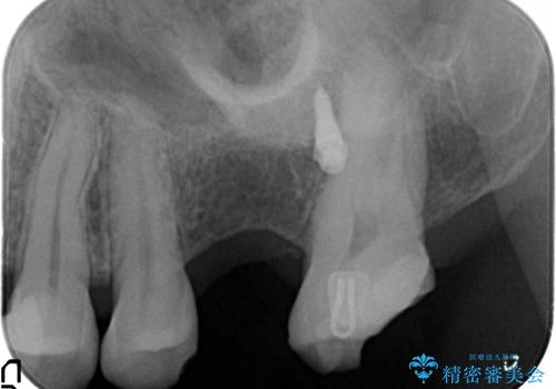 小矯正を併用し清掃性を高めた臼歯部ブリッジの治療中
