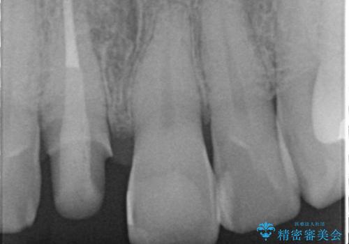 神経の死んだ歯の変色　前歯審美回復セラミック治療の治療中