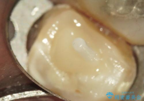 奥歯が痛む　根管治療→セラミックによるかみ合わせの回復までの治療中