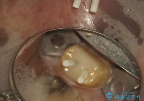 銀歯の下に2次的な虫歯が　土台からのやり直しの治療中