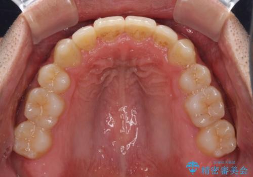 前歯のでこぼこをスッキリと　目立たない装置による抜歯矯正の治療後