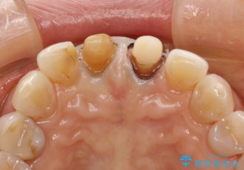 前歯のオールセラミックやり替え　複雑な色味を再現するの治療中