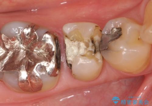 銀歯の下に2次的な虫歯が　土台からのやり直しの治療中