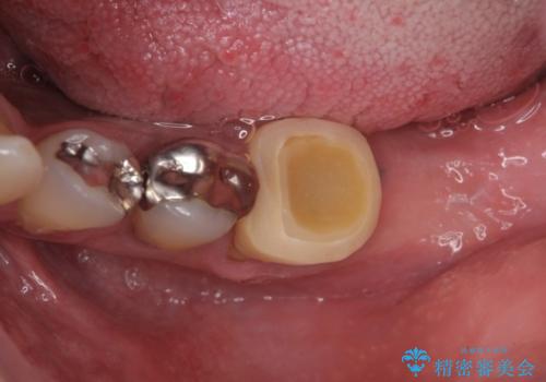 歯に穴が開いている　抜歯してインプラントへ　30代男性の症例 治療前