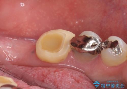 歯に穴が開いている　抜歯してインプラントへ　30代男性の治療前