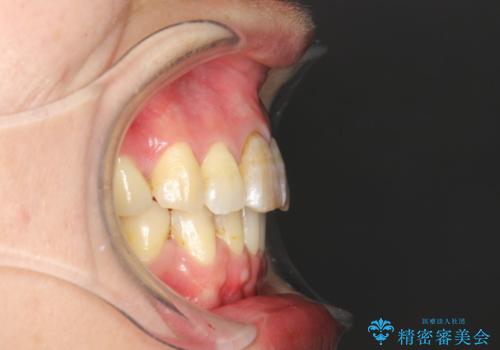 コルチコトミーを併用した上下出っ歯の抜歯矯正の治療後