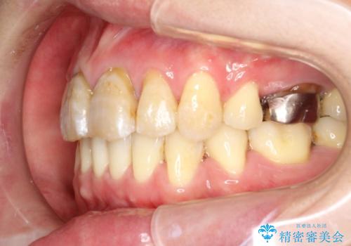 コルチコトミーを併用した上下出っ歯の抜歯矯正の治療後