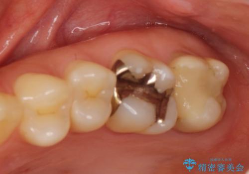 奥歯が痛む　根管治療→セラミックによるかみ合わせの回復までの治療前