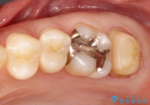 奥歯が痛む　根管治療→セラミックによるかみ合わせの回復までの治療中