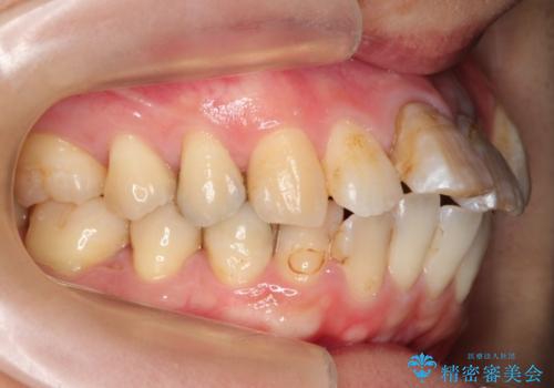 コルチコトミーを併用した上下出っ歯の抜歯矯正の治療前