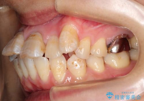 コルチコトミーを併用した上下出っ歯の抜歯矯正の症例 治療前