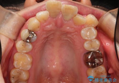 コルチコトミーを併用した上下出っ歯の抜歯矯正の治療前