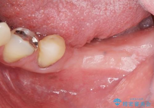 歯に穴が開いている　抜歯してインプラントへ　30代男性の治療中