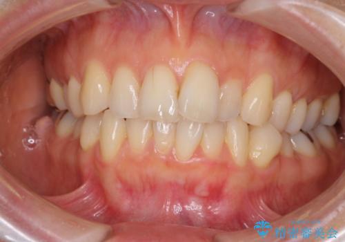 マウスピースで上下の歯のでこぼこを解消　インビザラインの症例 治療前