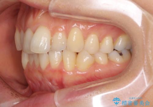 マウスピースで上下の歯のでこぼこを解消　インビザラインの治療前