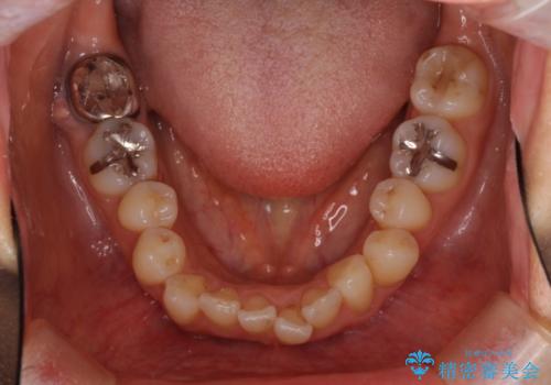 マウスピースで上下の歯のでこぼこを解消　インビザラインの治療前