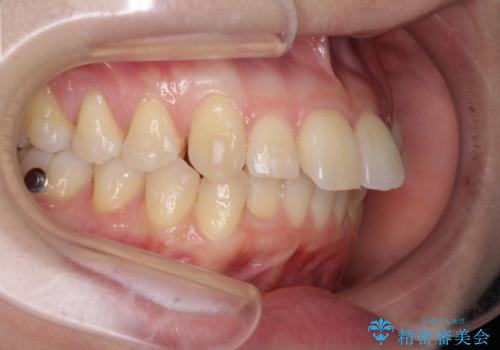 出っ歯が気になり笑えない インビザラインで出っ歯の治療の治療中