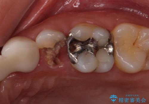 歯茎の中にまで及んだ大きなむし歯　抜歯をせずにセラミッククラウンにの症例 治療前