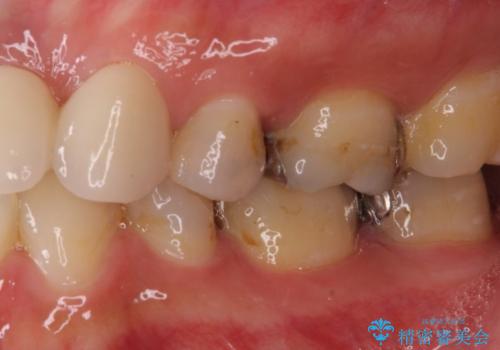 歯茎の中にまで及んだ大きなむし歯　抜歯をせずにセラミッククラウンにの治療前