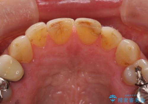 上の両前歯が欠けて年々短くなる　セラミック審美治療の治療前