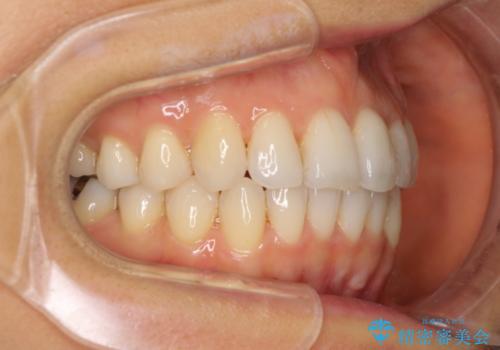 マウスピースで上下の歯のでこぼこを解消　インビザラインの治療後