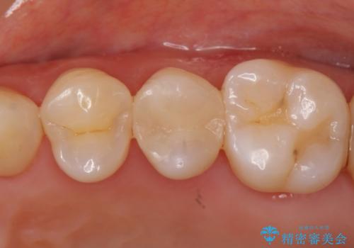 メタルを白い歯への症例 治療後