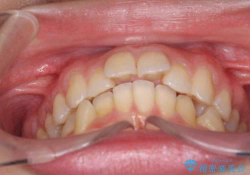 出っ歯が気になり笑えない インビザラインで出っ歯の治療の治療前