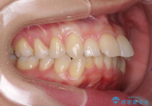 出っ歯が気になり笑えない インビザラインで出っ歯の治療の症例 治療前