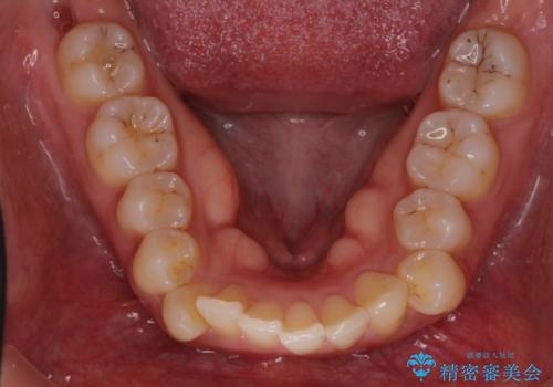 出っ歯が気になり笑えない インビザラインで出っ歯の治療の治療前