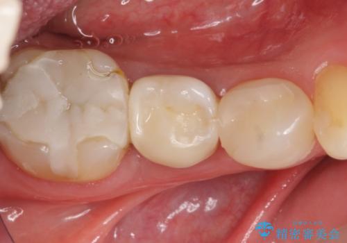 セラミックによる虫歯治療の治療後