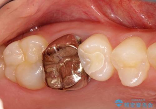 2次的な虫歯になった金属の被せもののやり直しの治療前