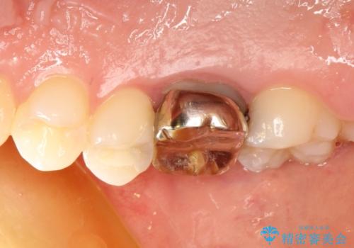 2次的な虫歯になった金属の被せもののやり直しの治療前