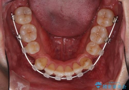 前歯のでこぼこをスッキリと　目立たない装置による抜歯矯正の治療中
