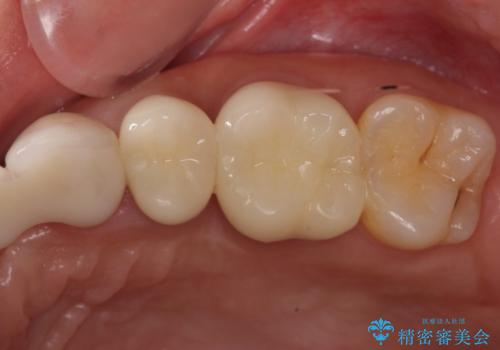 歯茎の中にまで及んだ大きなむし歯　抜歯をせずにセラミッククラウンにの治療後