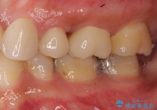 歯茎の中にまで及んだ大きなむし歯　抜歯をせずにセラミッククラウンにの治療後