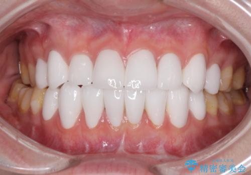 とにかく歯を白くしたい　前歯の審美歯科治療の症例 治療後